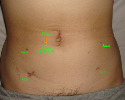 腹腔鏡手術の傷
