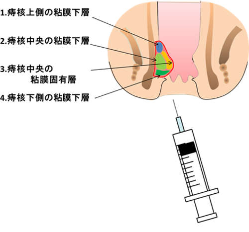 ジオン注治療